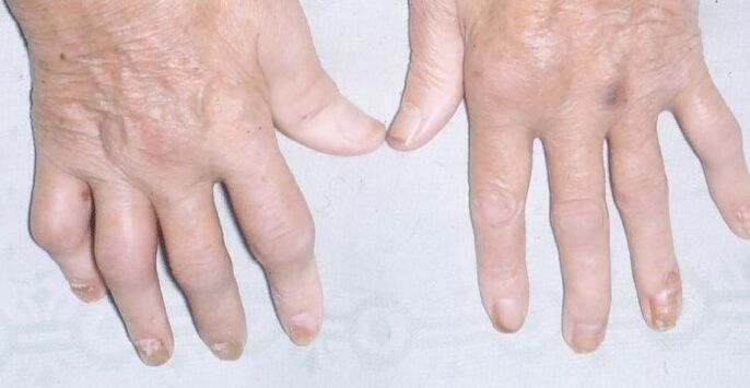 artropaatiline psoriaas kätel