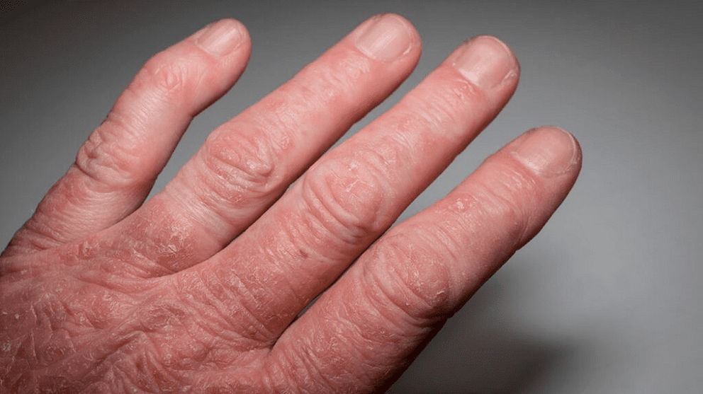 psoriaatiline artriit kätel