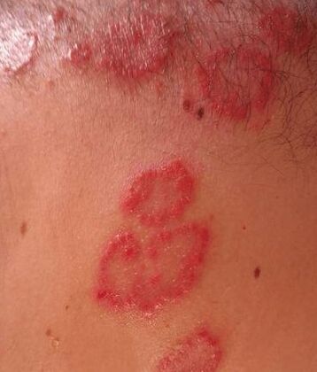Psoriaasi laigud