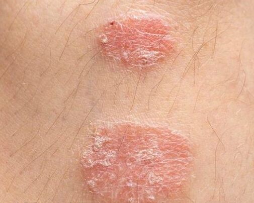 Psoriaatiliste naastude välimus