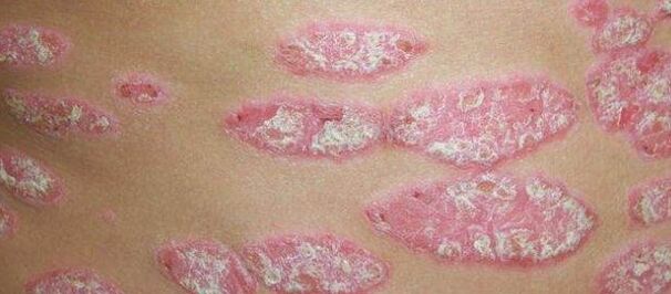 Psoriaasi progressiivne etapp