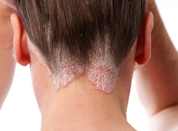 Psoriaatiline erütrodermia