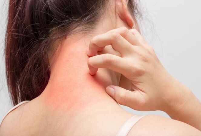 Sügelus on psoriaasi üks põhjusi