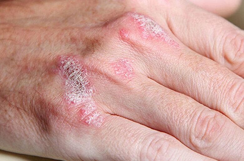 Ladomary püsitud psoriaas