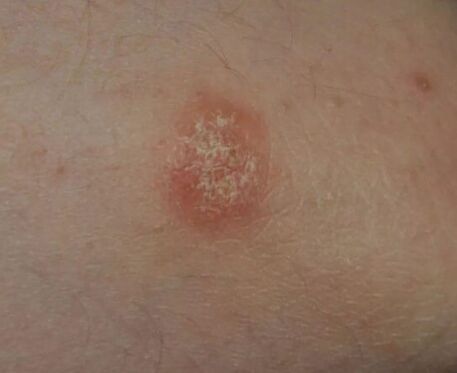 Psoriaasi koht