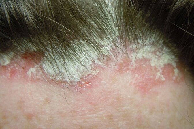 Psoriasis jäädvustab kogu pea karvase osa