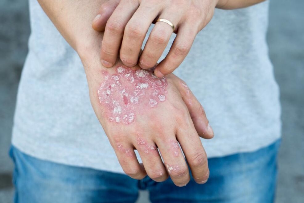 Psoriaas on