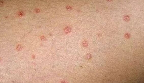 Psoriaasi algne etapp