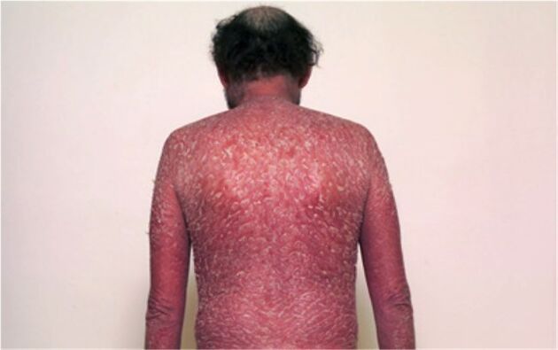 Psoriaasi kolmas etapp