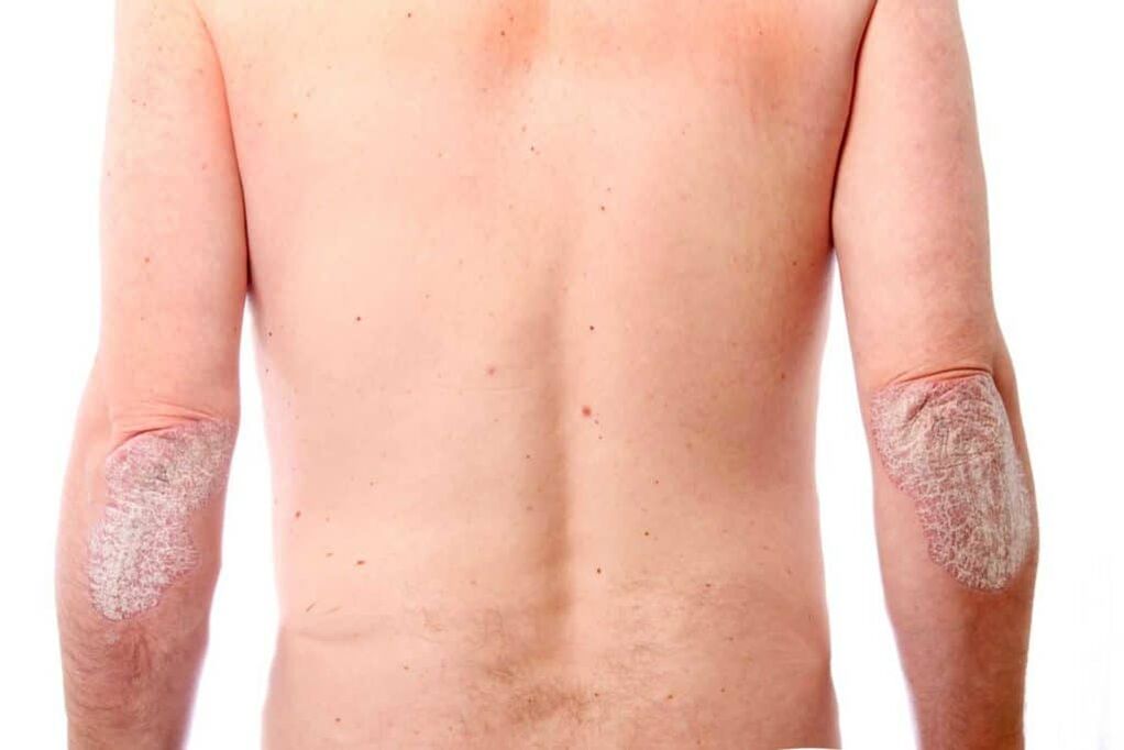 Psoriaasi teine etapp