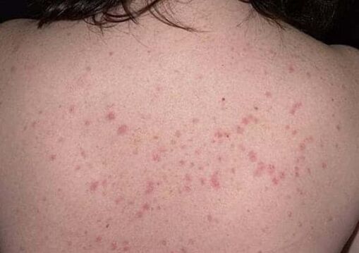 Psoriaasi algne etapp
