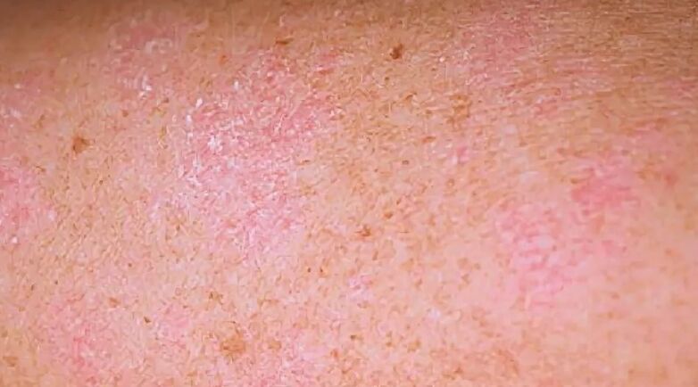 Psoriaasi regressiivne etapp