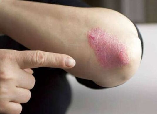 Psoriaasi statsionaarne etapp