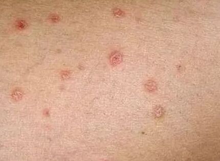 Algtapi psoriaas