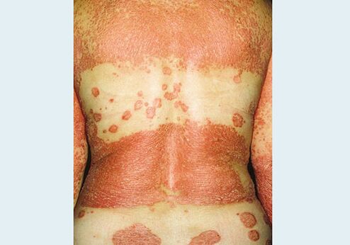 Suguelundite psoriaas