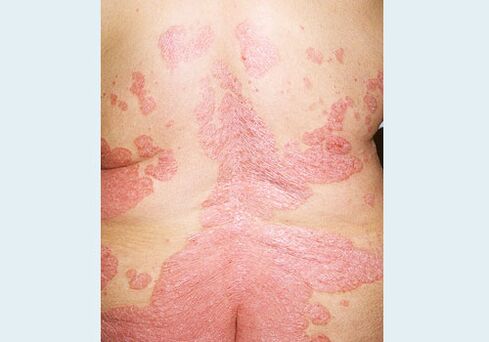 Tagaosa psoriaas