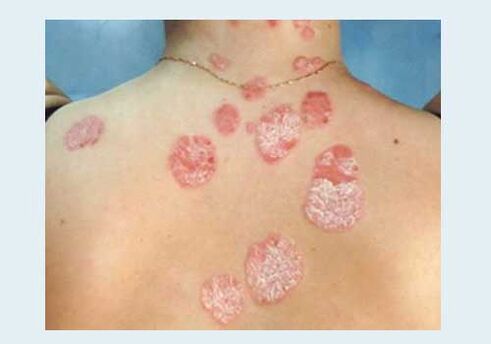 Tavaline psoriaas