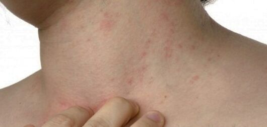 Psoriaas kaelas