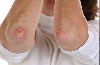 Psoriaas küünarnukkidel