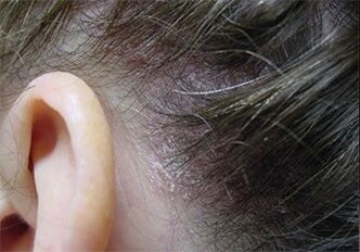 Psoriaas peas