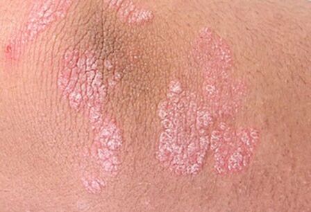 psoriaas
