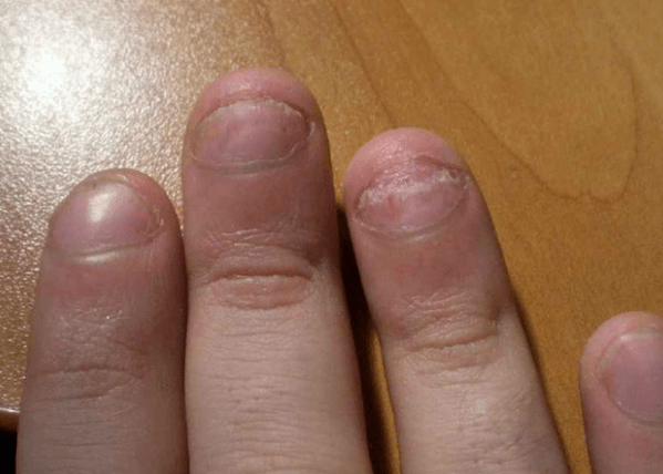 Küünte psoriaas
