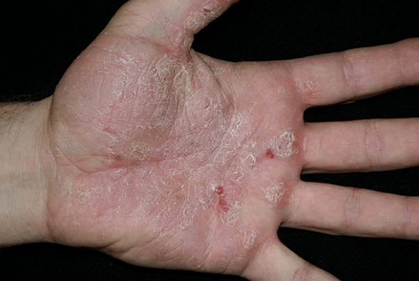 Psoriaas käes