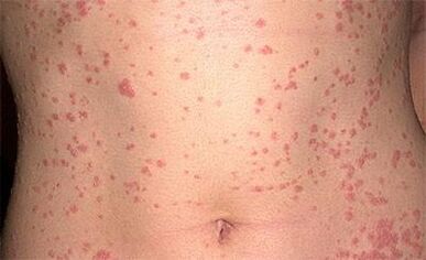 Psoriaas kehal
