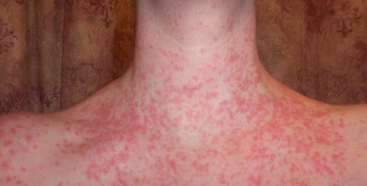 Psoriaas kehal