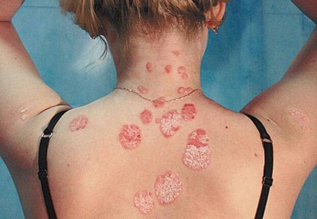 Psoriaas tagaküljel
