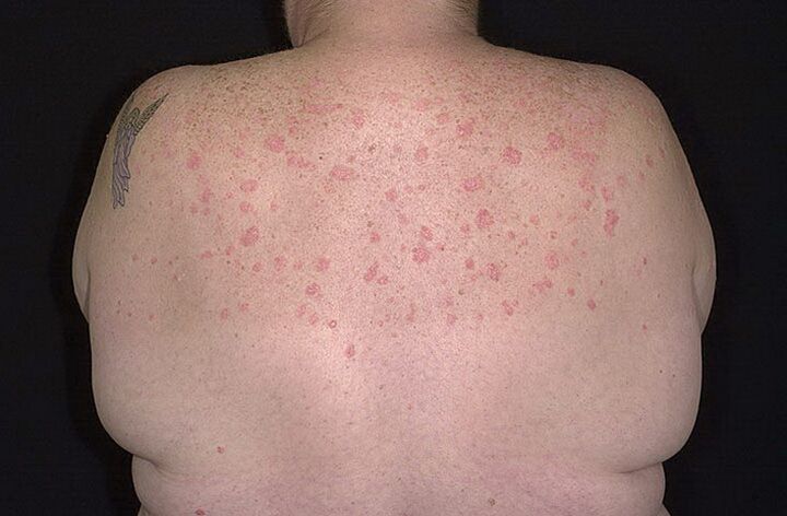 Psoriaas õlgadel