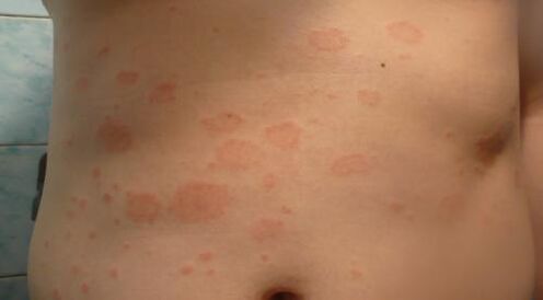 Algtapi psoriaas