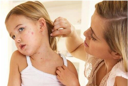 Foto psoriaasi algtapist