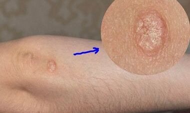 psoriaasi arengu etapid
