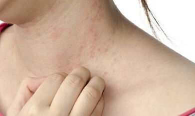 psoriaasi ravi kaugelearenenud staadiumis