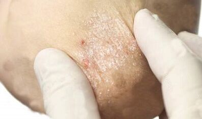 psoriaasi ravi nõrgenemise staadiumis