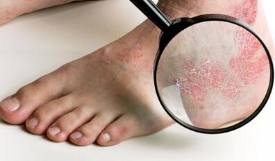 psoriaasi ravivõimalused