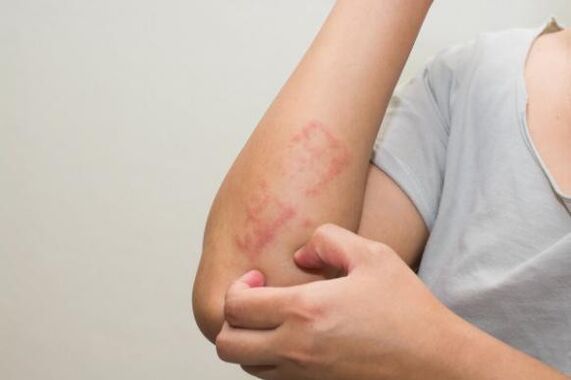 Viimased psoriaasi ravivad meetodid