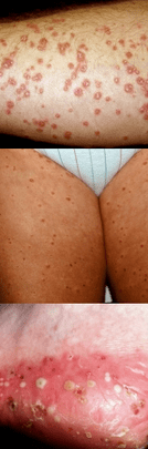 Psoriaas jalgadel