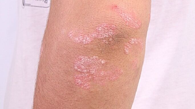 foto psoriaasi varases staadiumis
