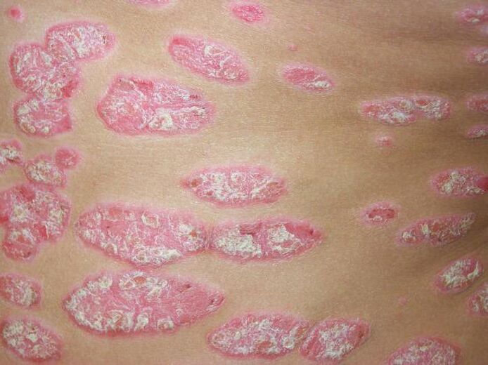 naastuline psoriaas