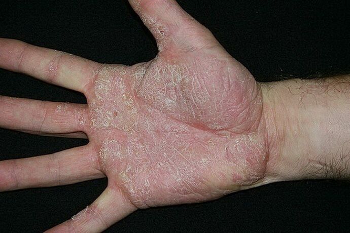 peopesade ja jalgade psoriaas