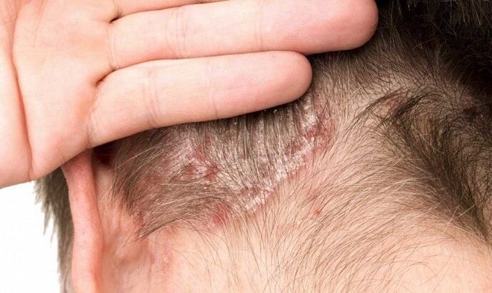 psoriaas peas