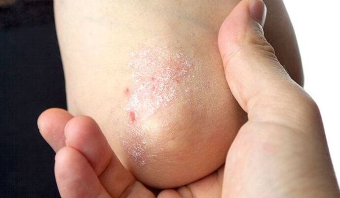psoriaasi sümptomid algstaadiumis