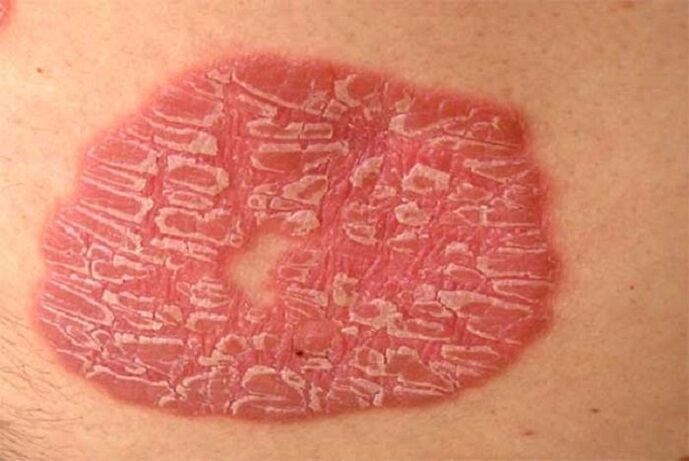 pustuloosne psoriaas