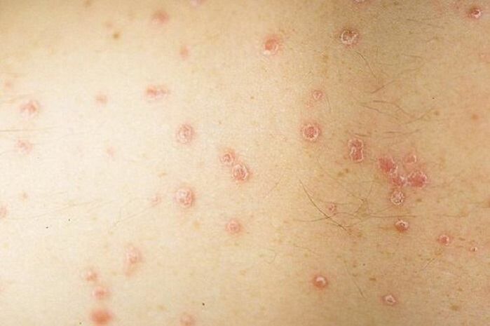täpilise psoriaasi sümptomid