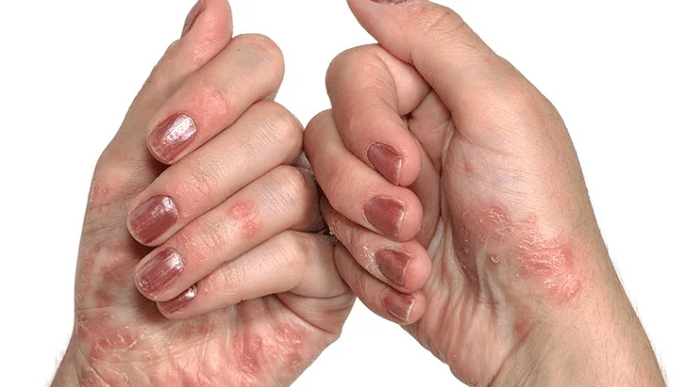 Psoriaasi algne etapp