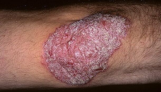 psoriaas